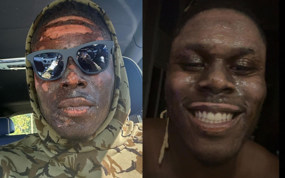 David Njoku Reveals His Complete Face Burns From A Home Accident