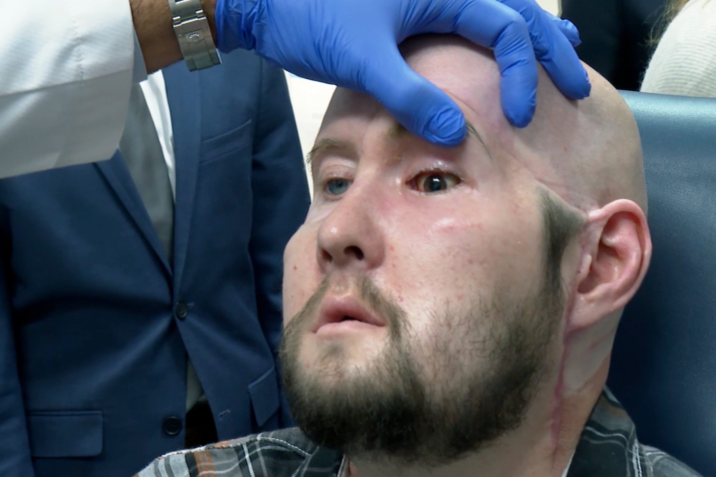 Aaron James Was Electrocuted And Lost Half Of His Face. He Recently Received The First-Ever Transplant Of His Face And Eyes
