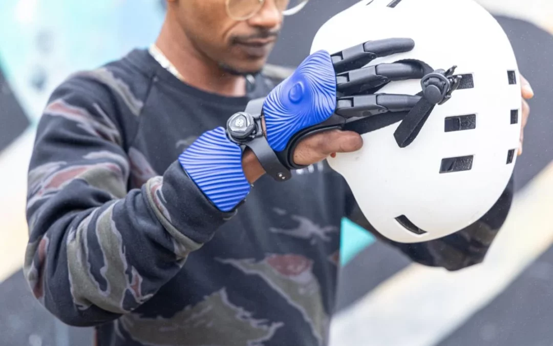 A Man Whose Hand Was Crushed By A Meat Grinder Became The First Person To Receive 3D-Printed Prosthetic Fingers